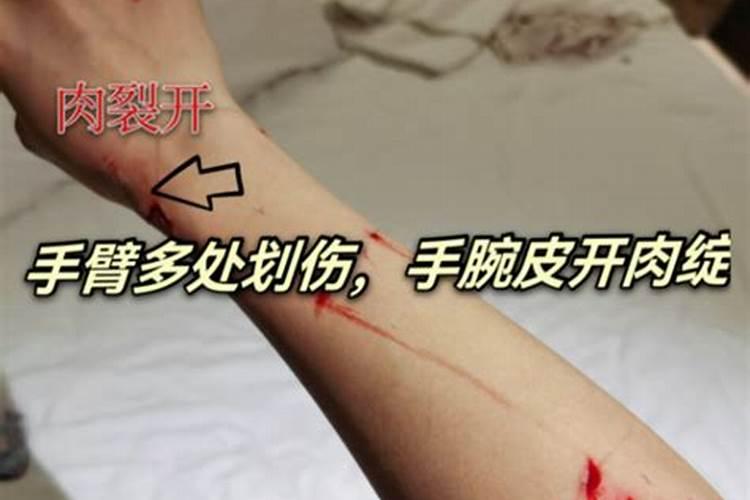 梦见手被割伤而且还缝了针的预兆